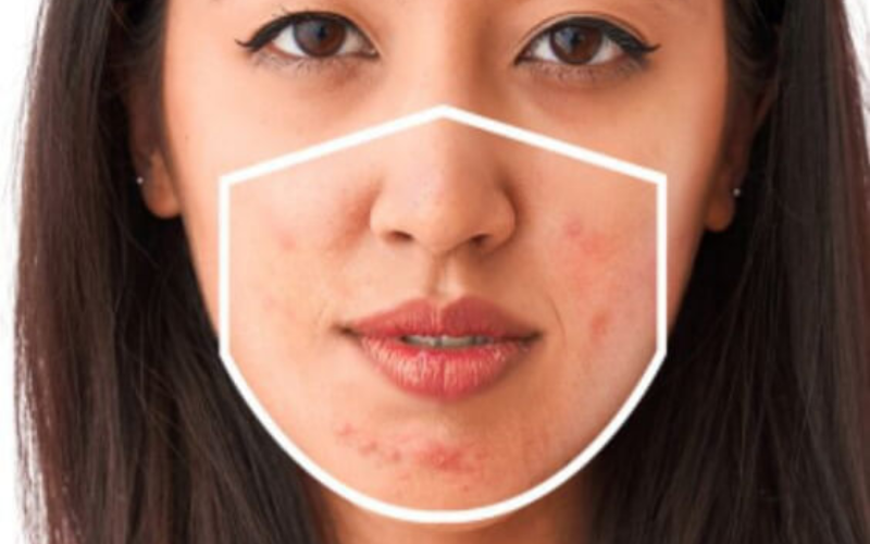 IS WEARING A FACE MASK CAUSING YOUR SKIN TO BREAK OUT? ozoneayurvedics